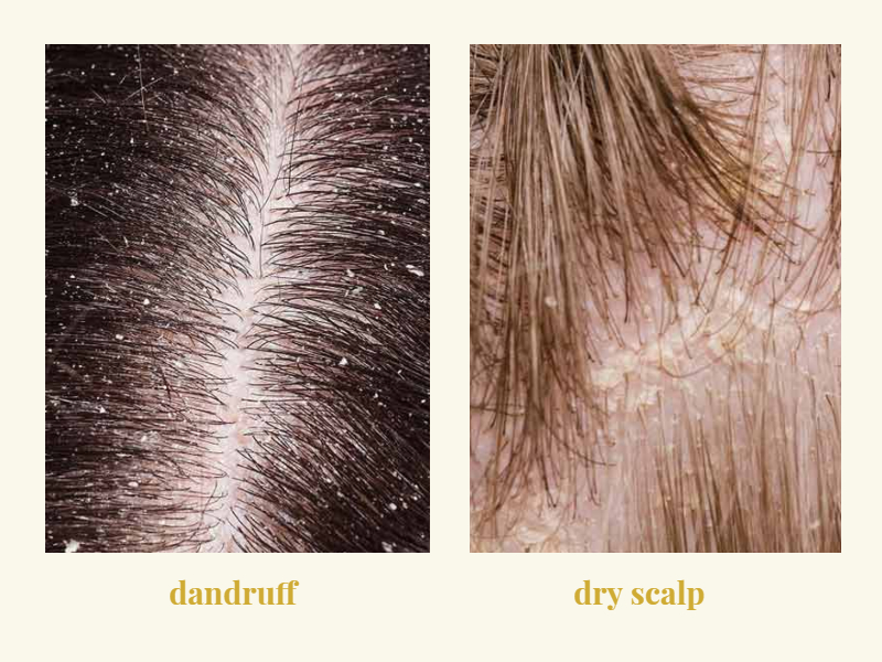 Dandruff vs. Dry Scalp: Understand the Difference & Find Relief