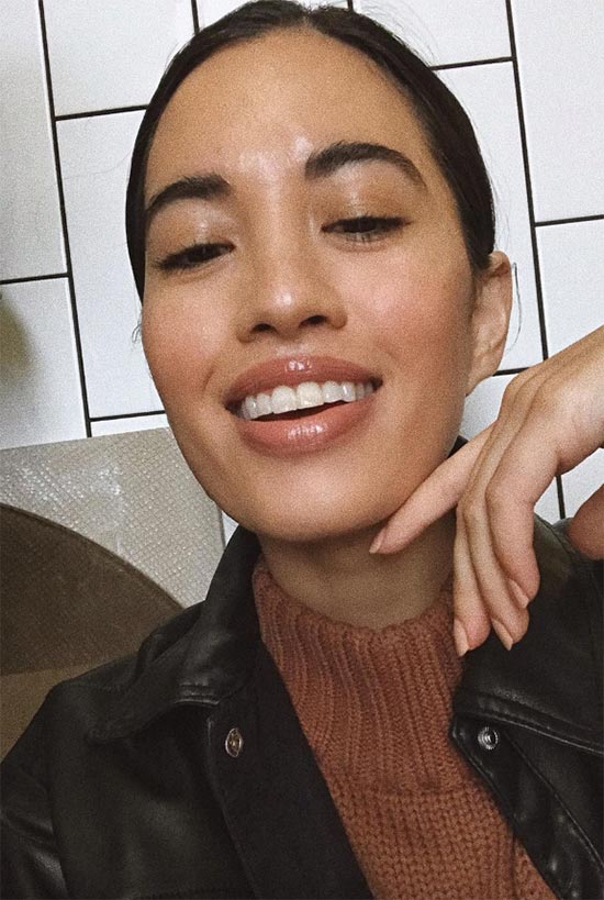 Understanding & Minimizing Smile Lines (Nasolabial Folds)