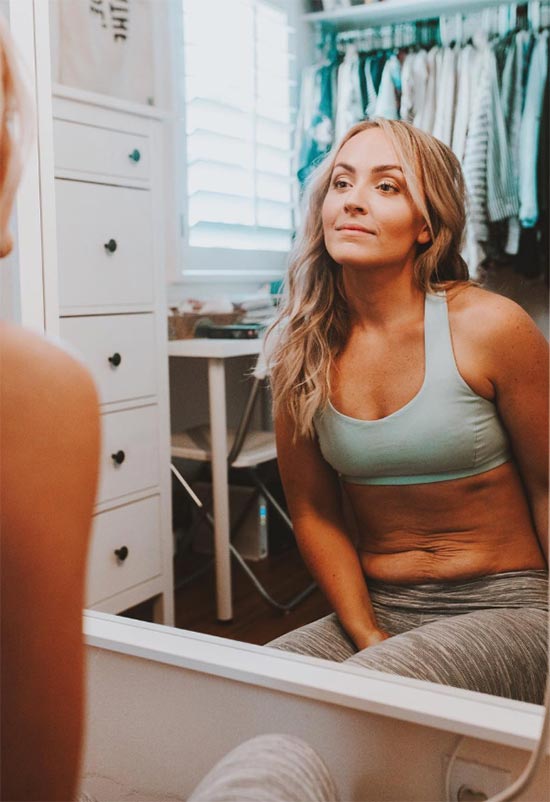 Effective Stretch Mark Removal: Creams, Treatments & Prevention