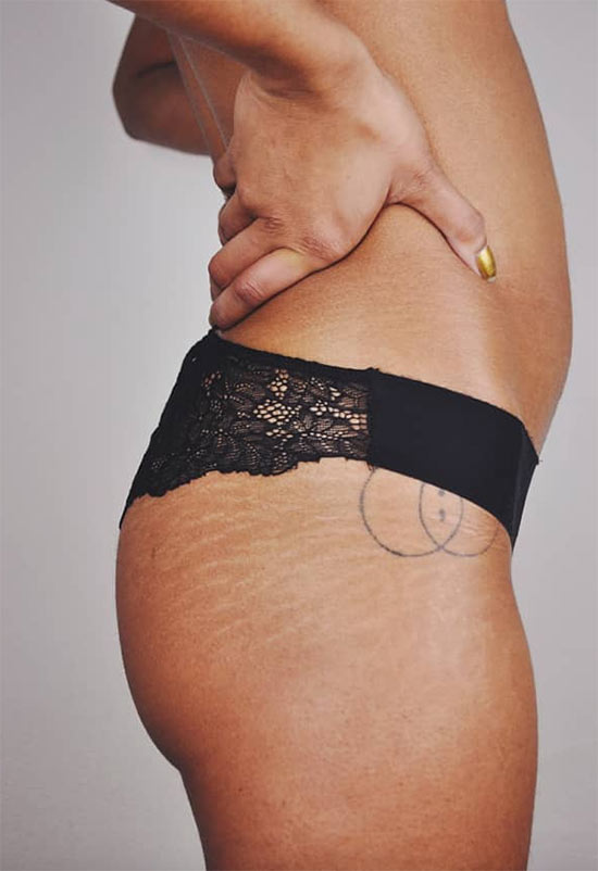 Effective Stretch Mark Removal: Creams, Treatments & Prevention