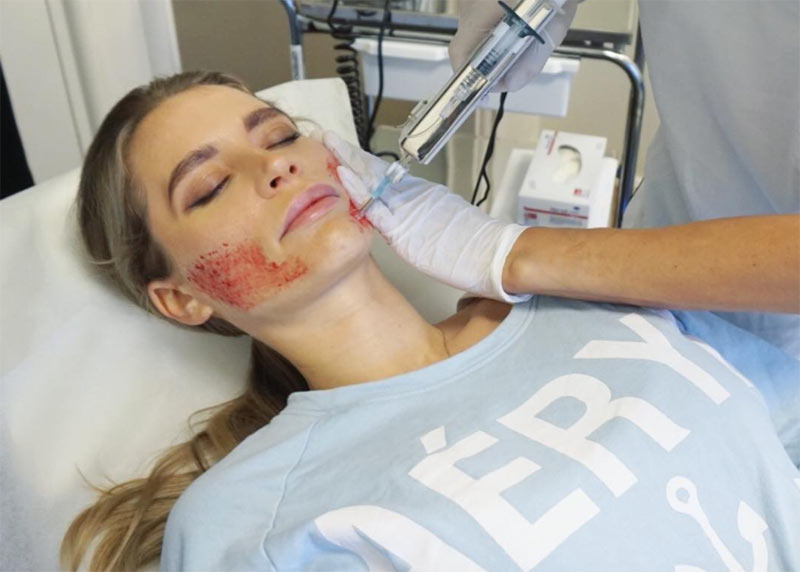 Microneedling at Home: A Comprehensive Guide to Derma Rollers
