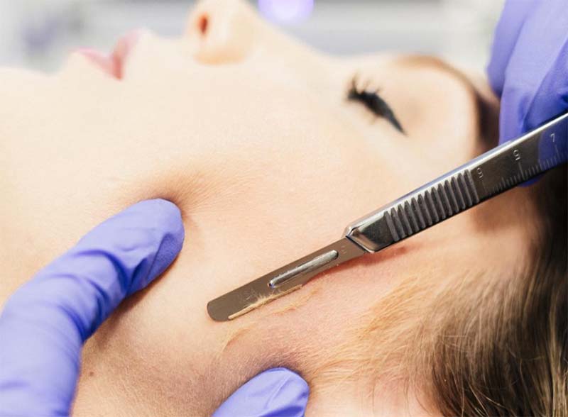 Dermaplaning: Your Complete Guide to At-Home & Professional Treatments