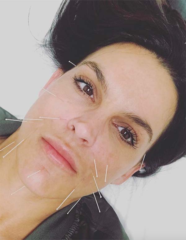Cosmetic Acupuncture: Benefits, Costs & What to Expect