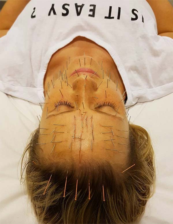 Cosmetic Acupuncture: Benefits, Costs & What to Expect