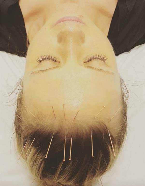 Cosmetic Acupuncture: Benefits, Costs & What to Expect