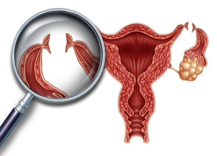 Tubal Sterilization: Understanding the Procedure & Permanence