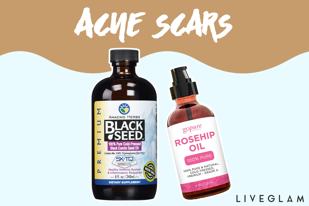 Facial Oils: Benefits & How They Can Help Your Skin (Even with Acne)