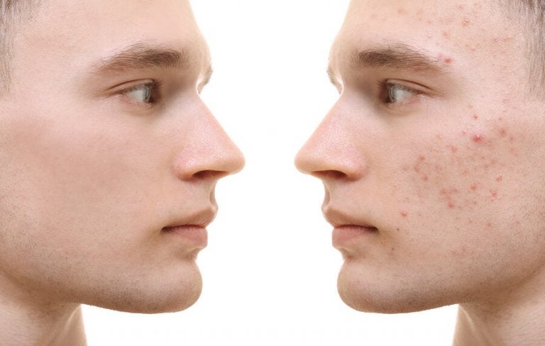 Turmeric for Acne: A Natural Treatment Guide