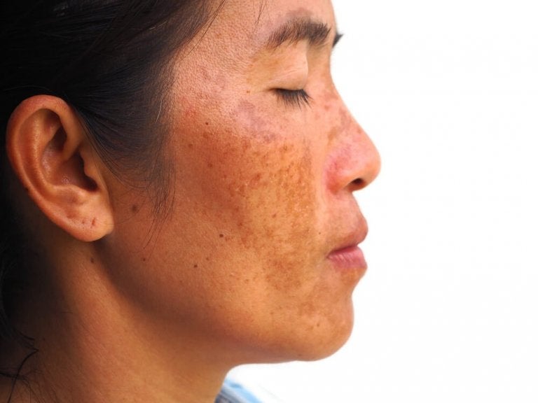 Melasma Treatment: Exploring Natural Remedies & Sun Protection