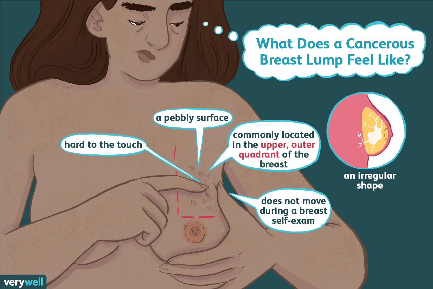 Understanding Breast Lumps: Benign vs. Malignant