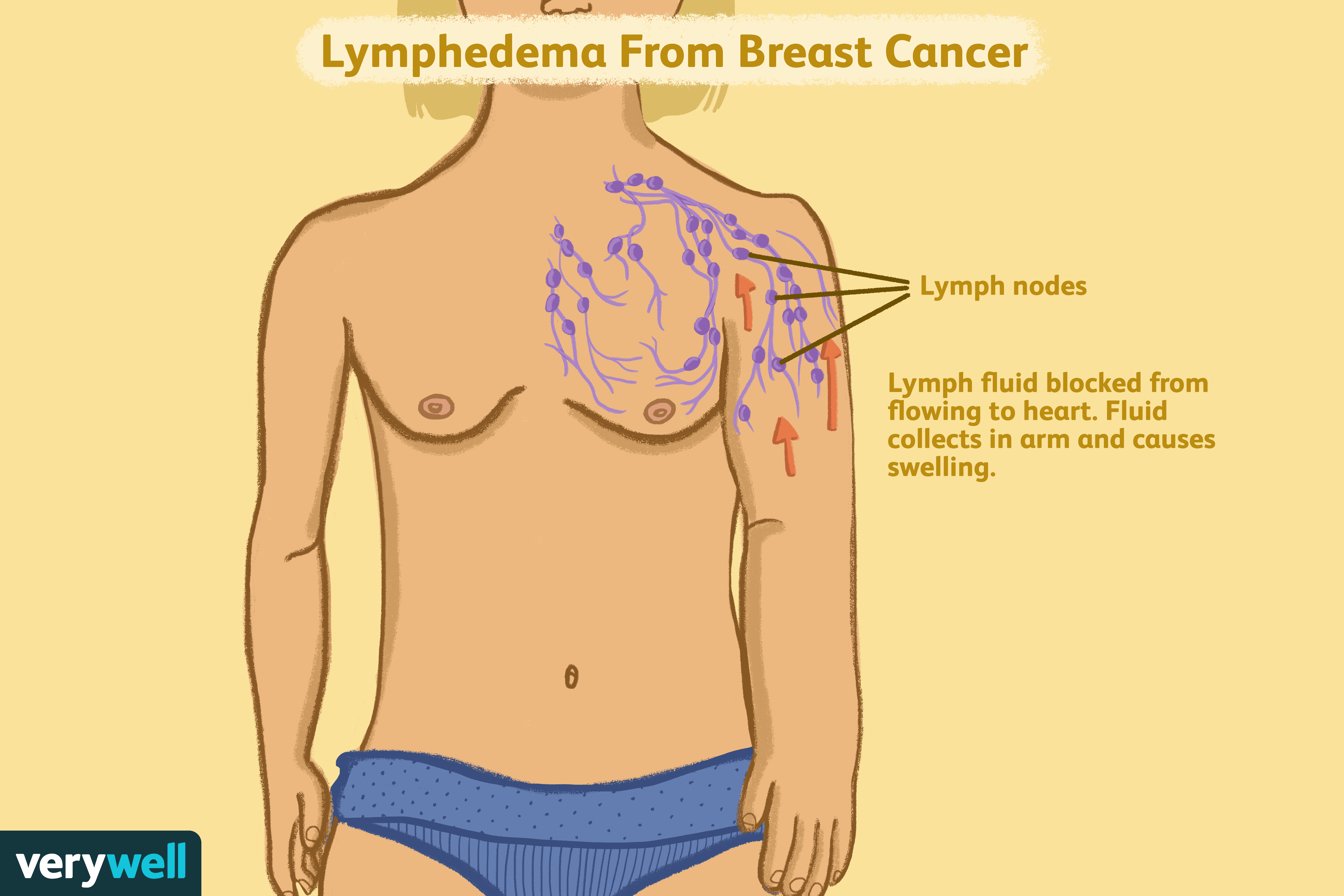Lymphedema and Breast Cancer: Causes, Symptoms & Management