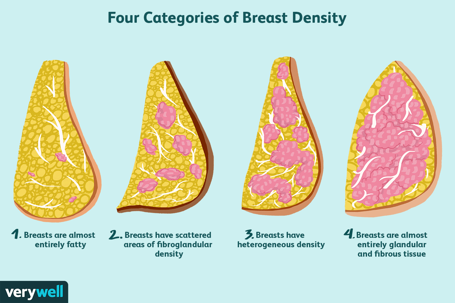Breast Density and Breast Cancer Risk: What You Need to Know