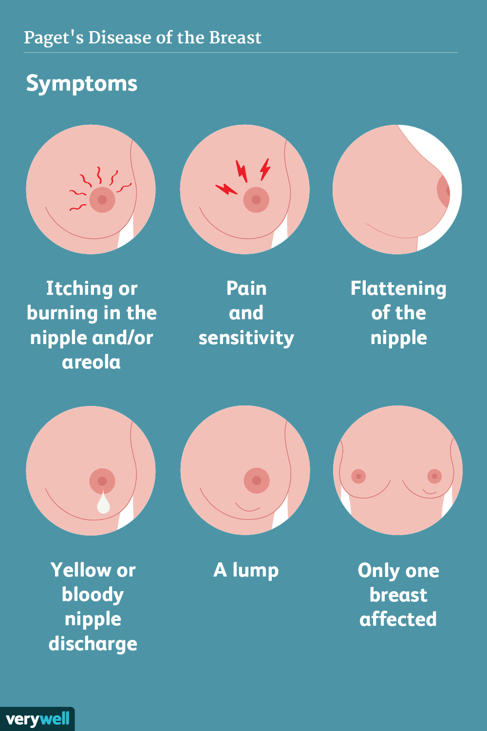 Understanding Breast Cancer Types: A Comprehensive Guide