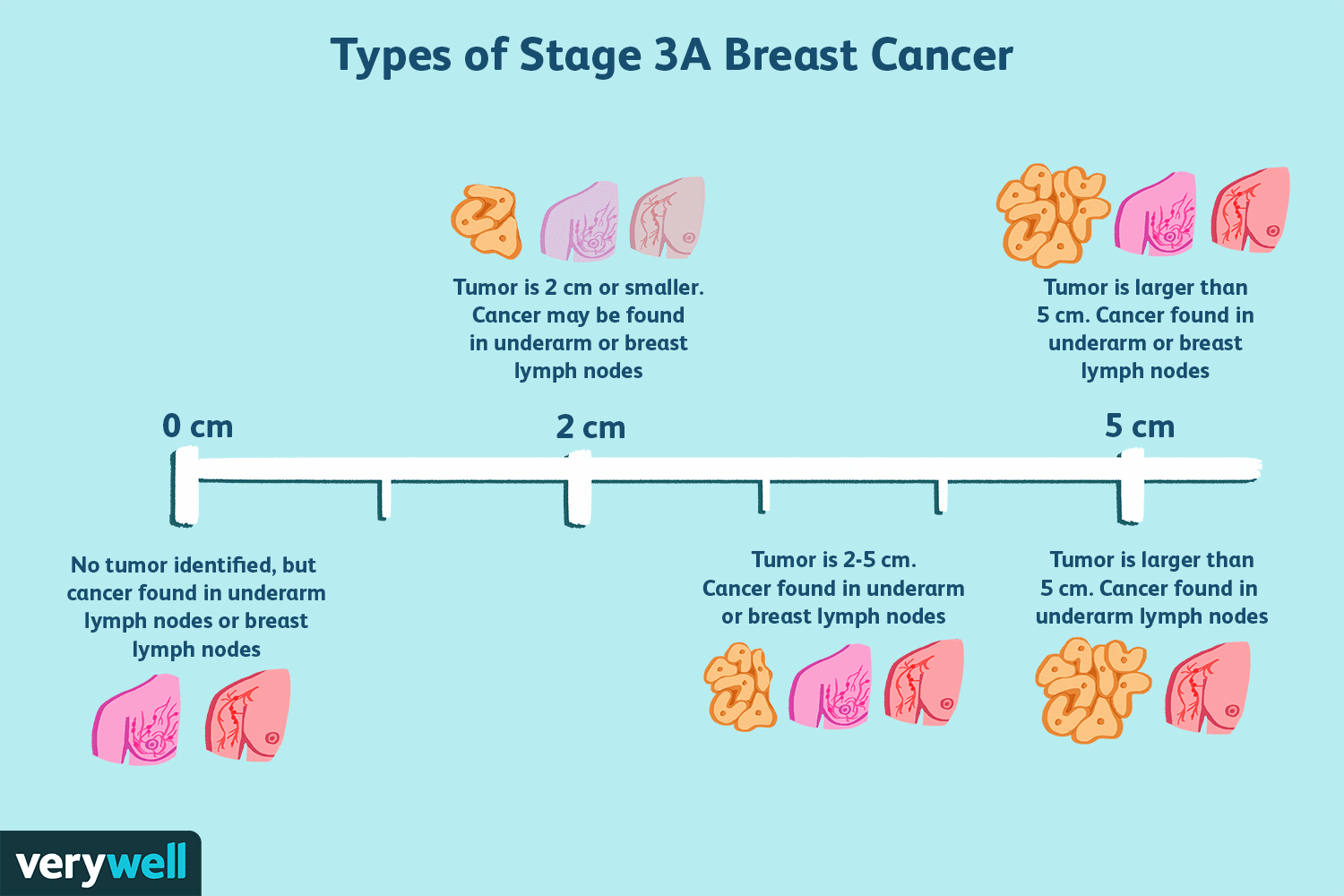 Understanding Stage 3 Breast Cancer: Symptoms, Treatment & Prognosis