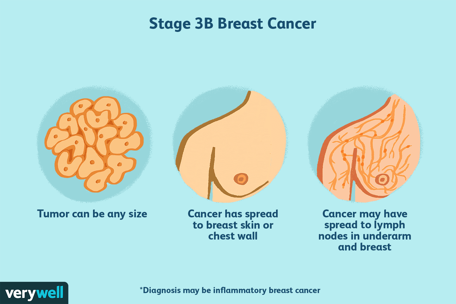 Understanding Stage 3 Breast Cancer: Symptoms, Treatment & Prognosis
