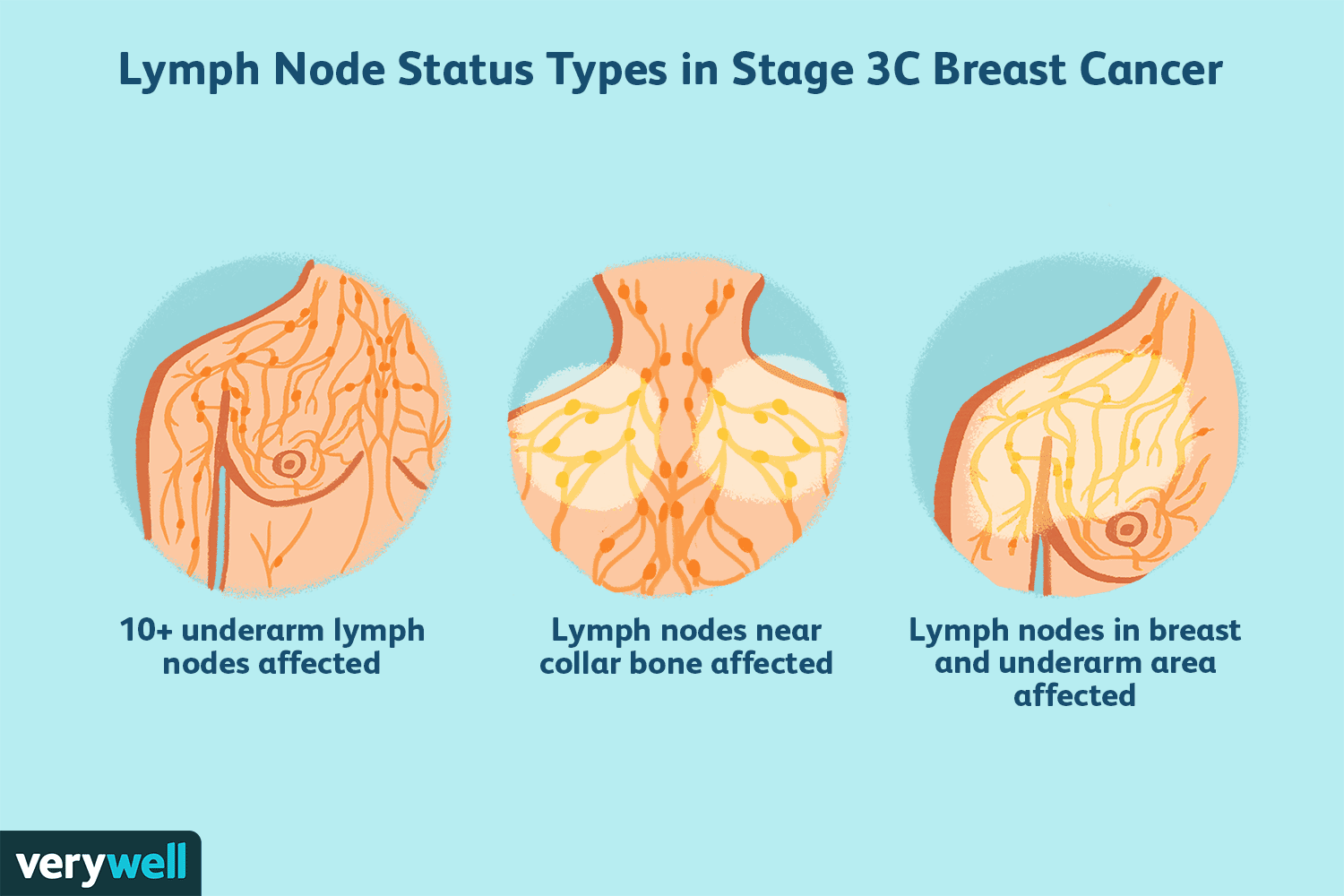Understanding Stage 3 Breast Cancer: Symptoms, Treatment & Prognosis
