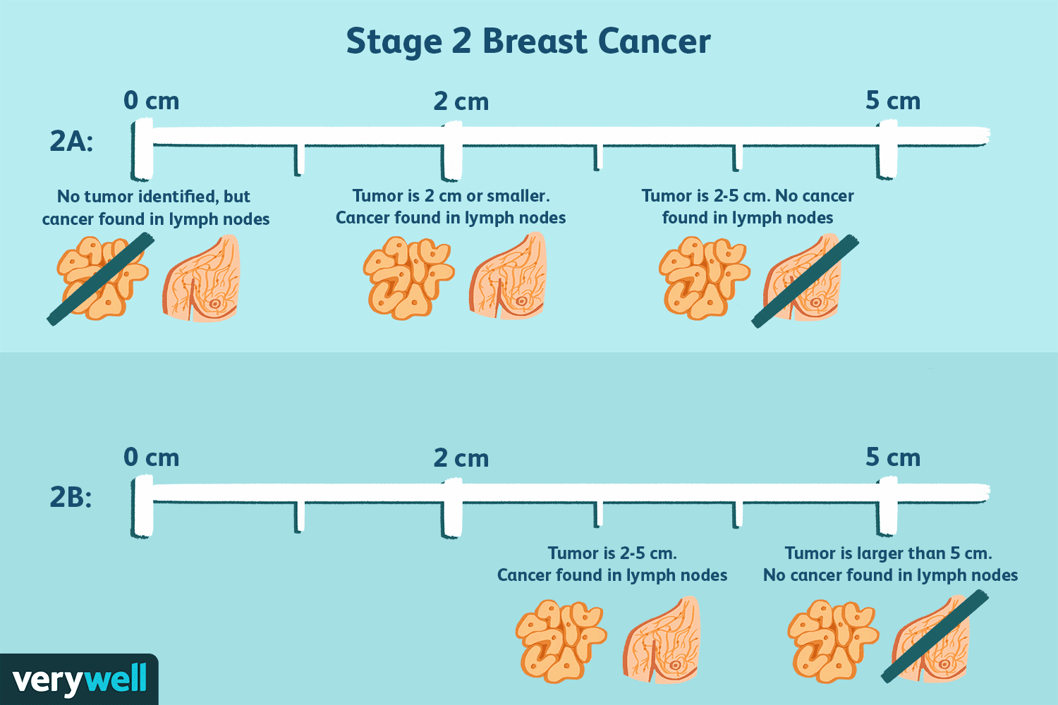 Understanding Stage 2 Breast Cancer: Causes, Treatment & Outlook