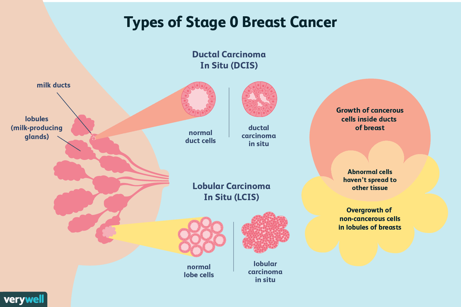Understanding Stage 0 Breast Cancer (DCIS): Symptoms, Treatment & Prognosis