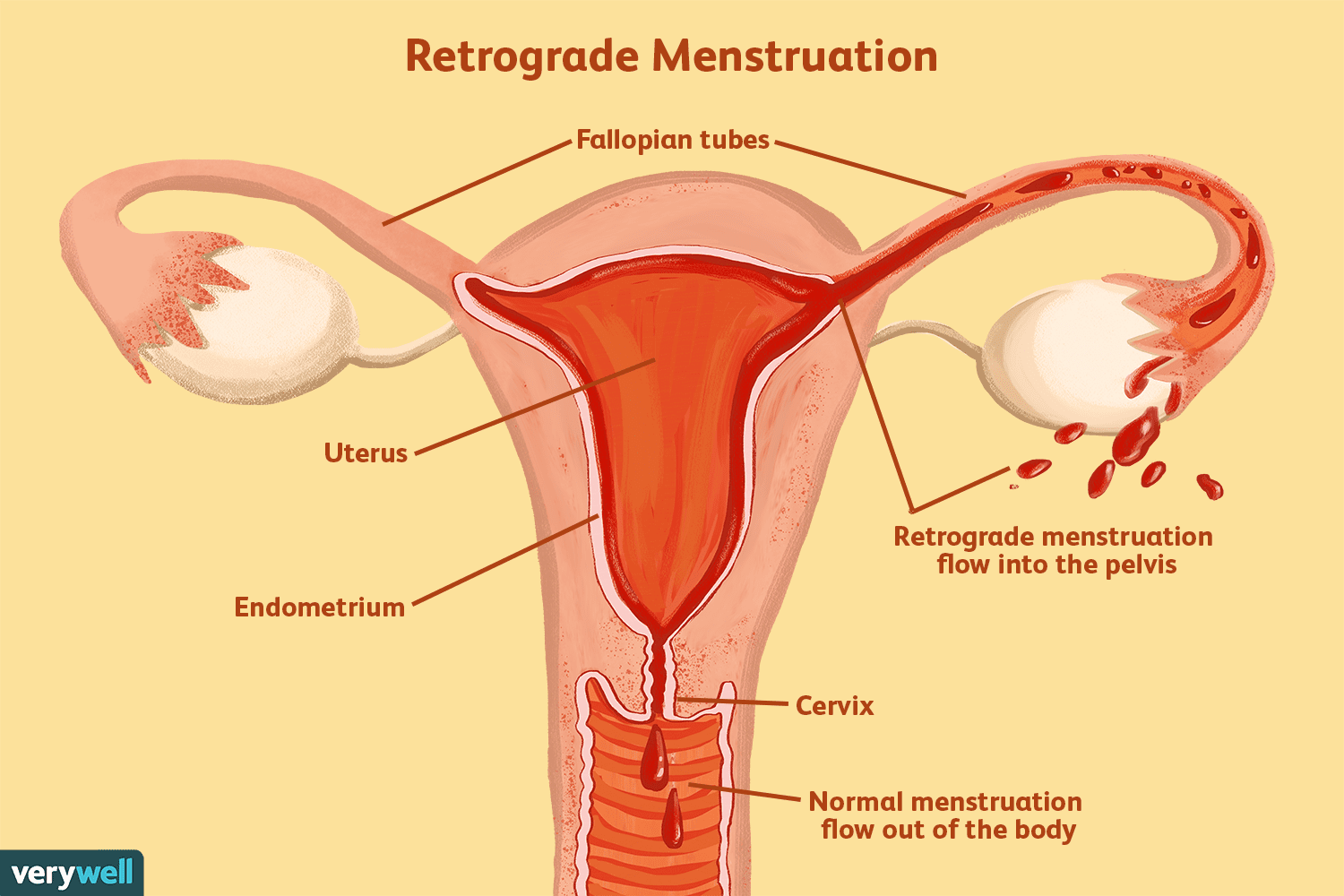 Retrograde Menstruation: Understanding the Condition & Potential Risks