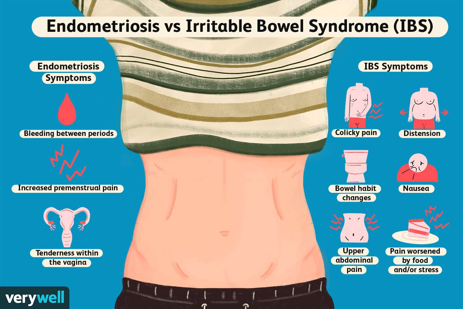 Endometriosis vs. IBS: Understanding Overlapping Symptoms