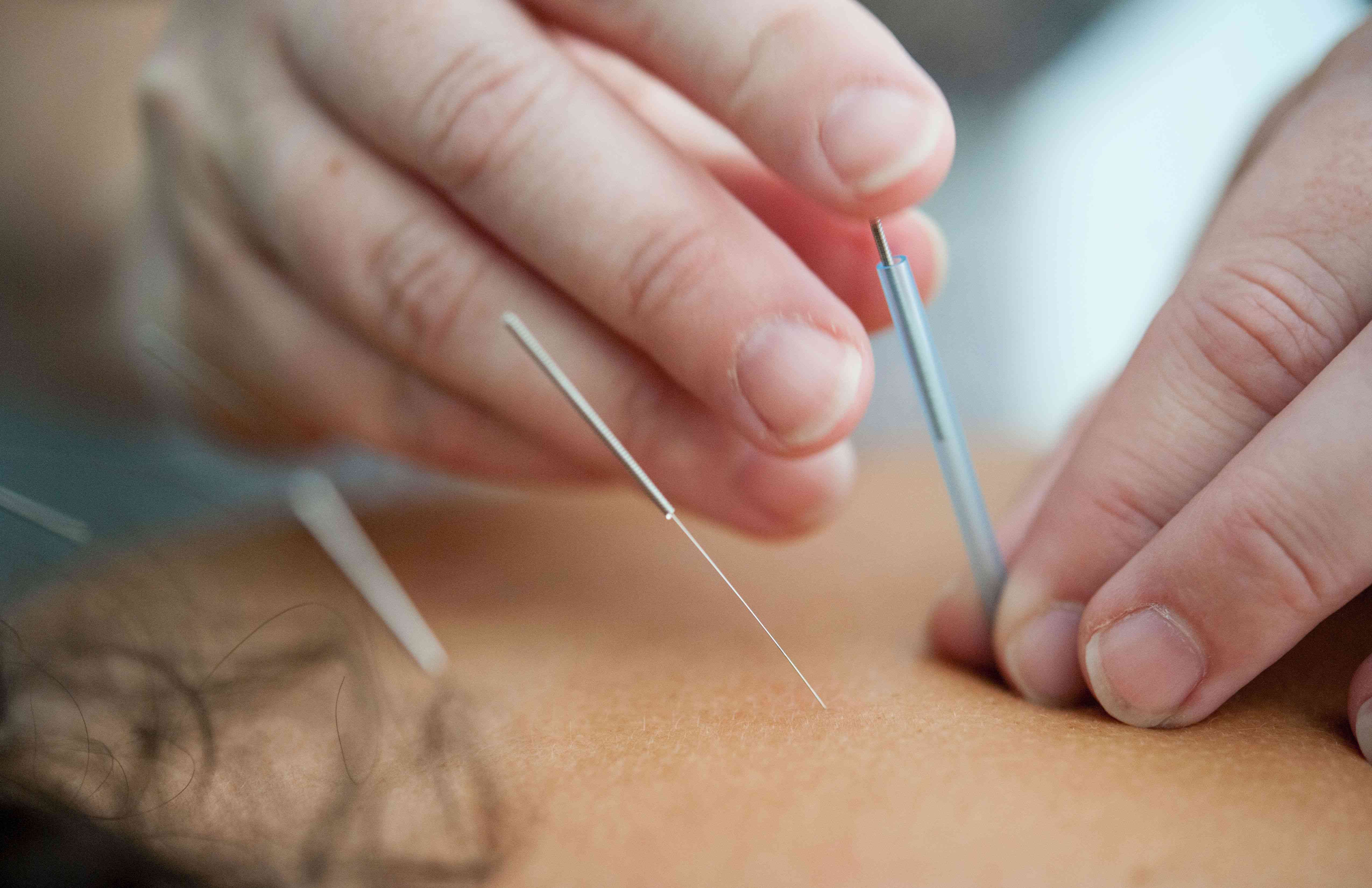 Acupuncture for Weight Loss: Does it Really Work?