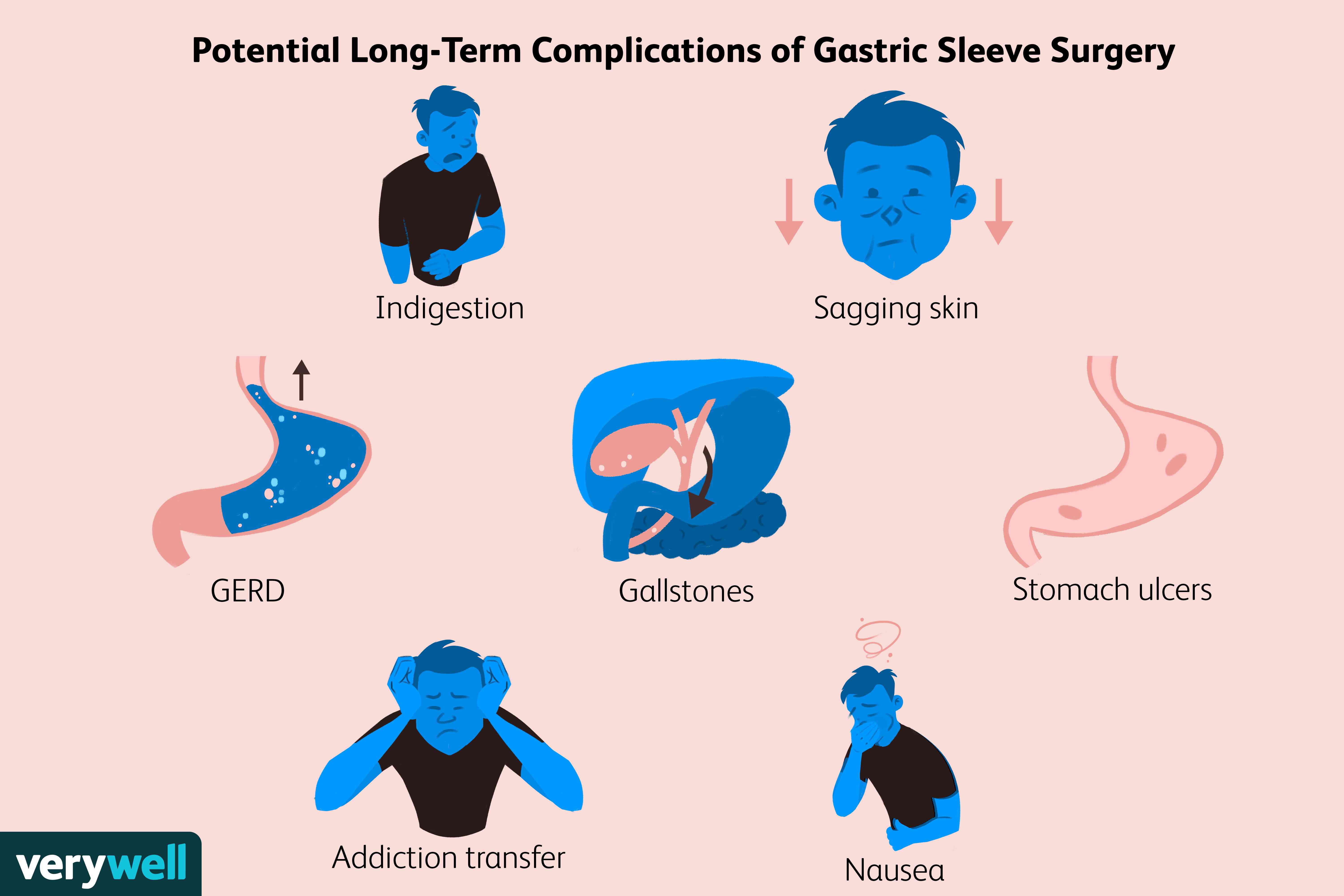 Gastric Sleeve Surgery: Potential Long-Term Complications & Recovery