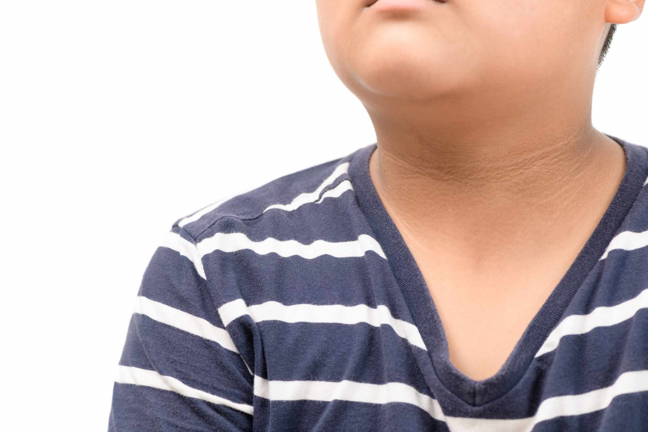 Acanthosis Nigricans: Causes, Symptoms & Connection to Obesity
