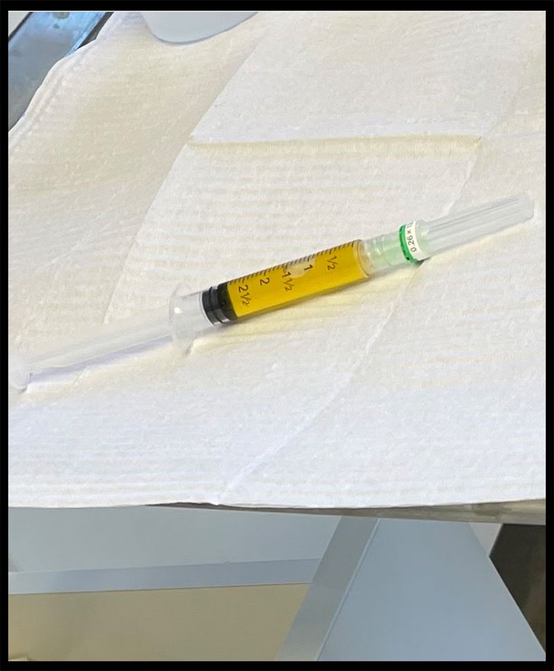 PRP for Dark Circles: A Personal Review & Results