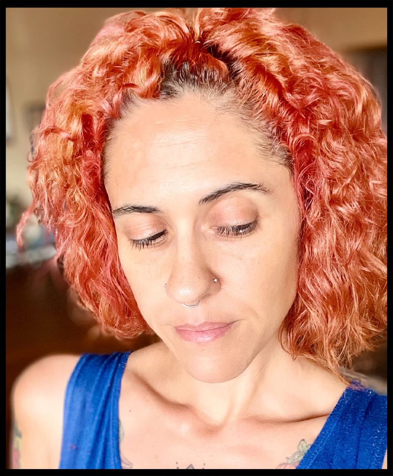 PRP for Dark Circles: A Personal Review & Results