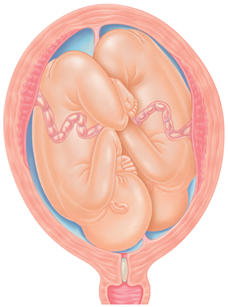 Preparing for a Twin Pregnancy: Essential Tips & Information
