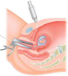 CVS vs. Amniocentesis: Understanding Diagnostic Testing Options