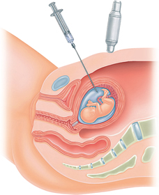 CVS vs. Amniocentesis: Understanding Diagnostic Testing Options