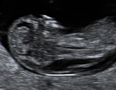 Nuchal Translucency Screening: Understanding Your Baby s Down Syndrome Risk