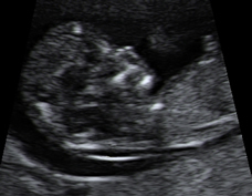 Nuchal Translucency Screening: Understanding Your Baby s Down Syndrome Risk