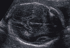 Understanding Your First Ultrasound: What to Expect