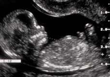 Understanding Your First Ultrasound: What to Expect