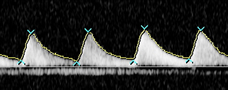 Understanding Fetal Growth: Charts & Monitoring