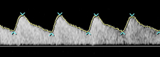 Understanding Fetal Growth: Charts & Monitoring