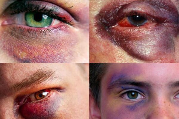 Effective Ways to Conceal and Reduce Under-Eye Bruises