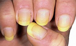 Nail Fungus from Manicures: Prevention & Treatment