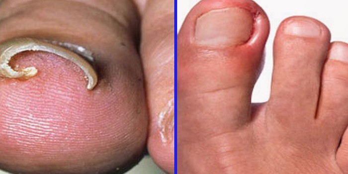 Nail Fungus from Manicures: Prevention & Treatment