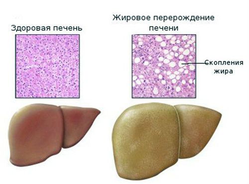 Liver Pain During Pregnancy: Causes, Relief & Safe Treatments