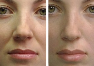 Reduce Lip Folds & Nasolabial Folds with Acupressure: A Natural Approach