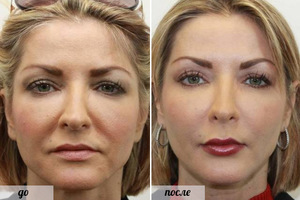 Reduce Lip Folds & Nasolabial Folds with Acupressure: A Natural Approach