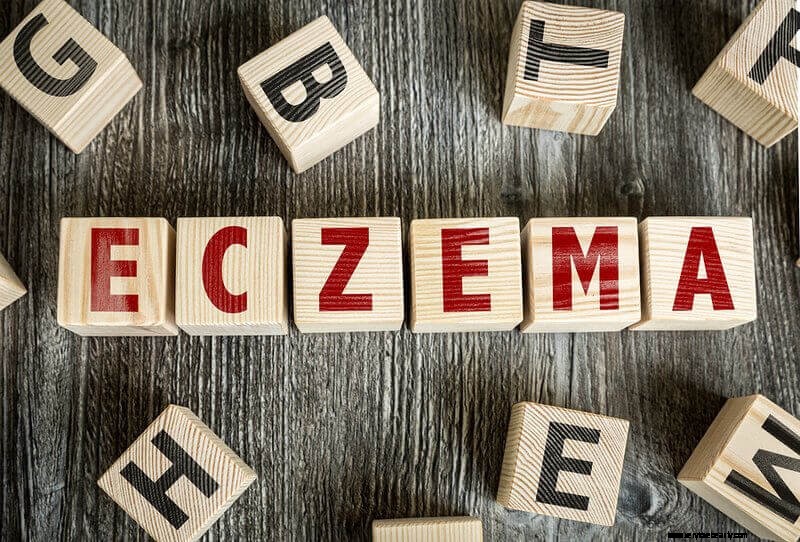 Understanding and Avoiding Eczema Triggers: A Holistic Approach