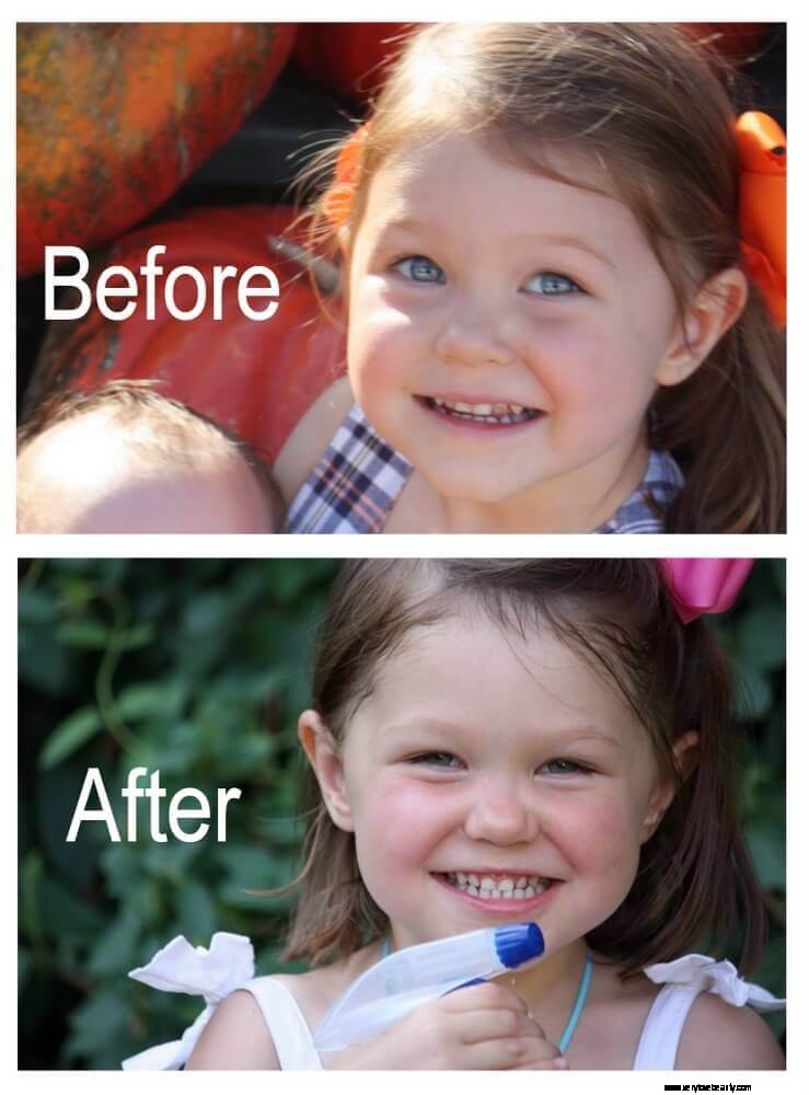 Reversing Childhood Tooth Decay: A Parent s Journey