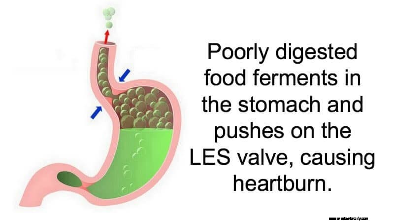 Understanding Heartburn: Causes, Symptoms & Relief