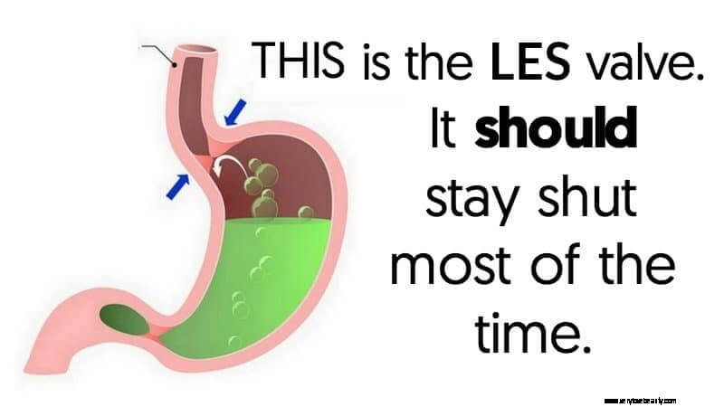 Understanding Heartburn: Causes, Symptoms & Relief