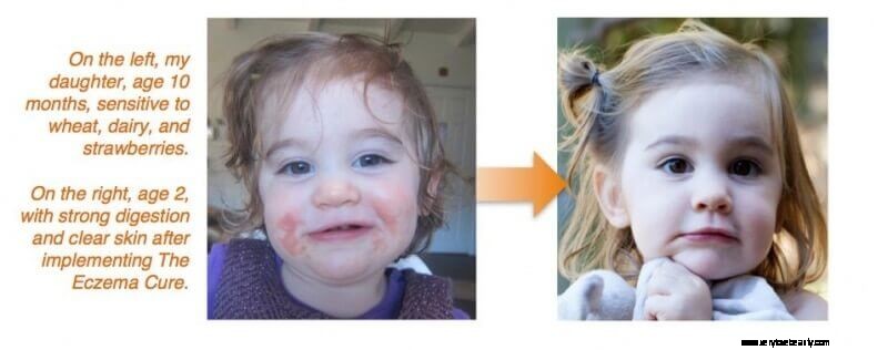 Understanding and Managing Eczema: A Personal Journey