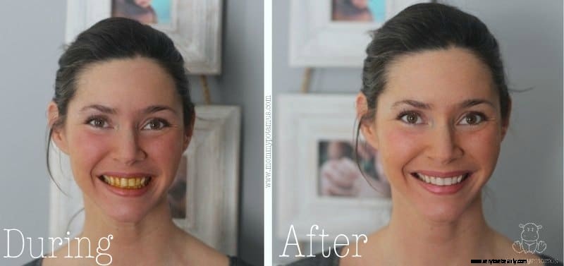 Natural Teeth Whitening with Turmeric: A Safe & Effective Guide